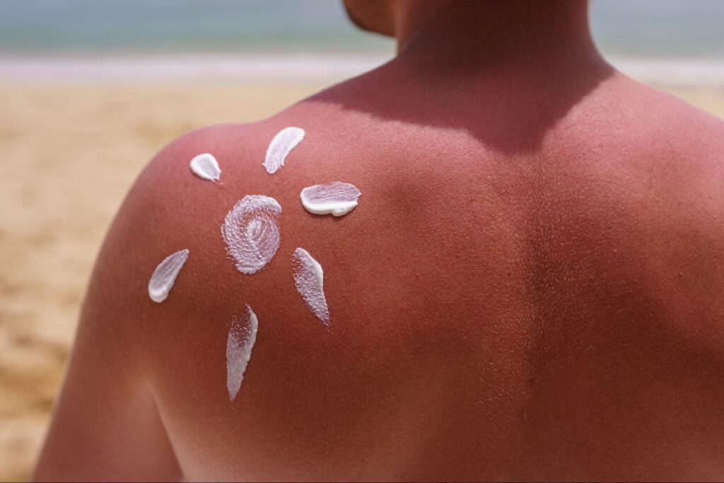 Sunscreen cream applied in a sun shape on a man's sunburnt back at the beach.