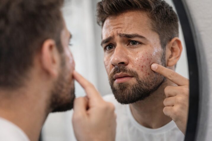 Man looking at acne and red pimples on his cheek while checking his skin in the mirror