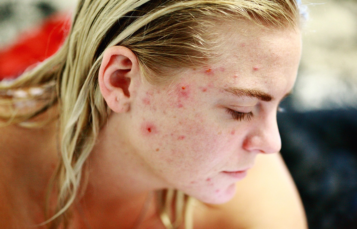 Side profile of a woman with visible acne and blemishes on her cheek
