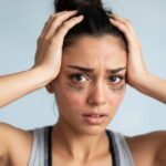 Woman holding her head with visible acne and dark circles after a workout