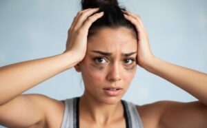 Woman holding her head with visible acne and dark circles after a workout