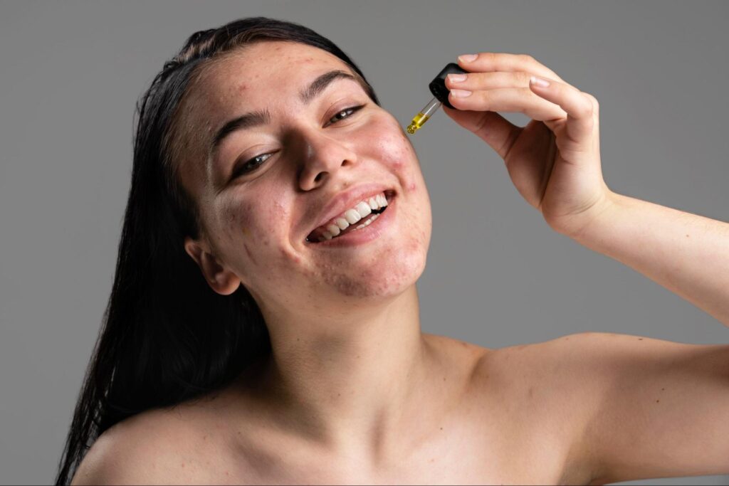 A close-up of a smiling young woman with visible acne applying a yellow facial serum to her cheek using a dropper, set against a plain grey background.