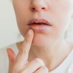 A close-up of a person's mouth showing severely dry, cracked, and irritated lips with a finger pointing to a cold sore.