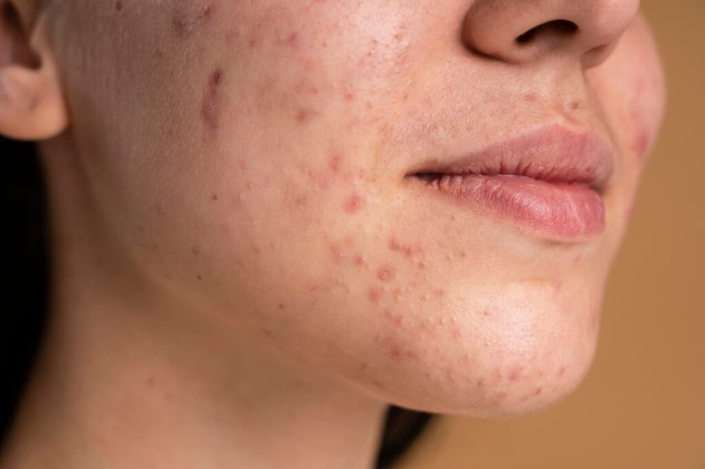 Pillows Cause Acne